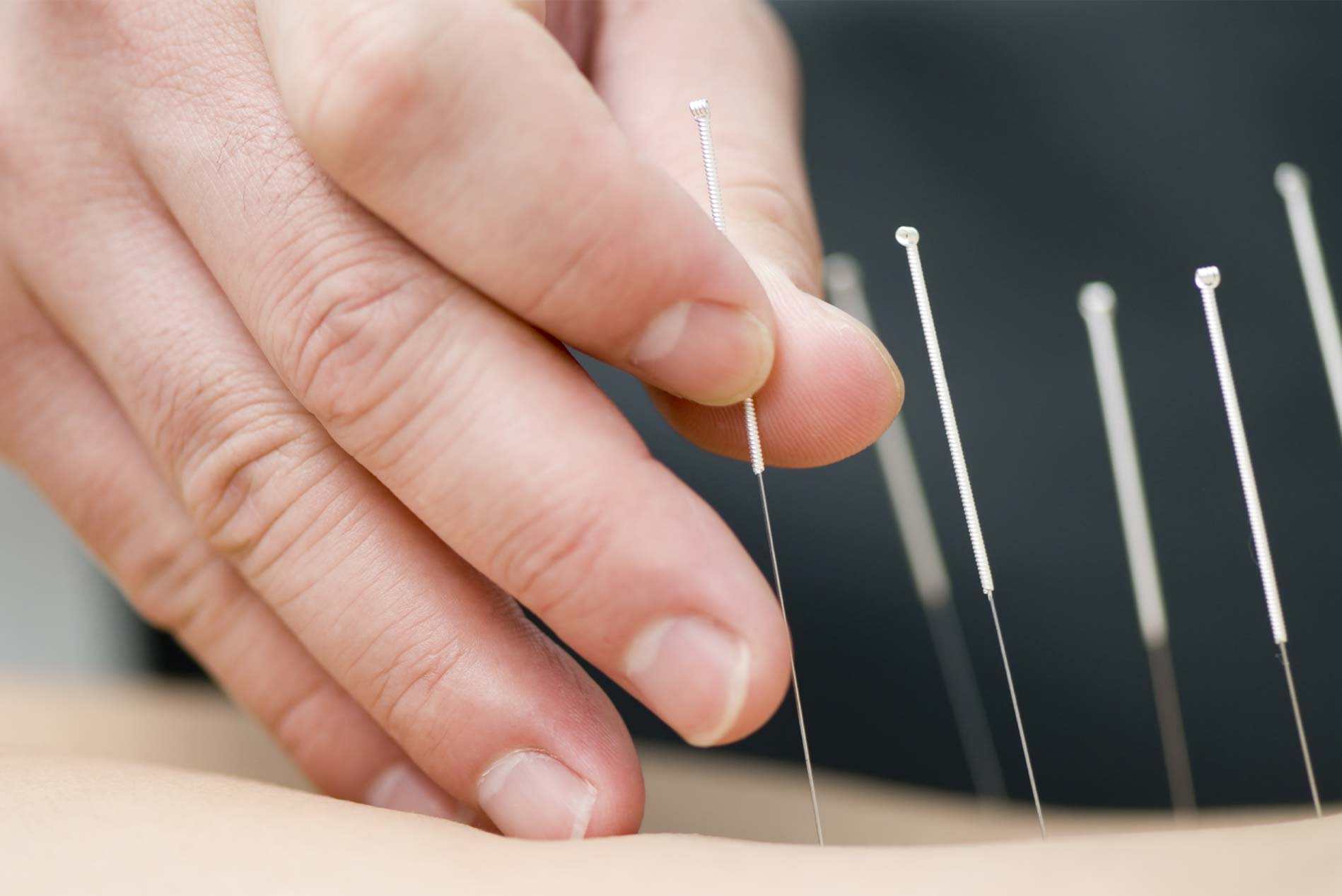 acupuncture