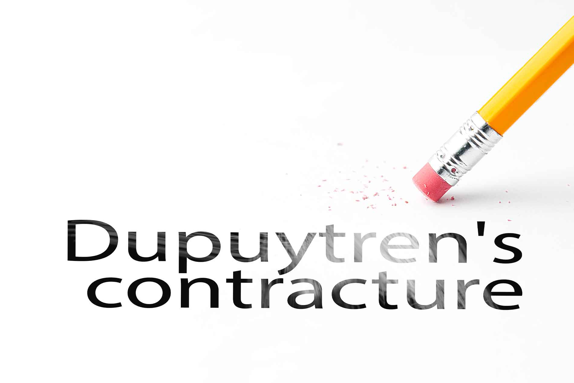 dupuytrens-contracture
